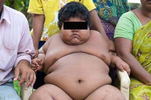 Ожирение у детей фото